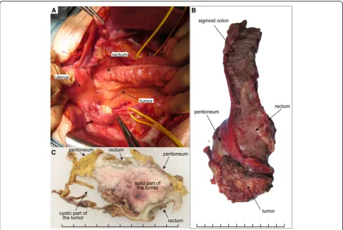 Fig. 2 a Pelvic laparotomy revealed the rectum compressed by the tumor in the mesorectum