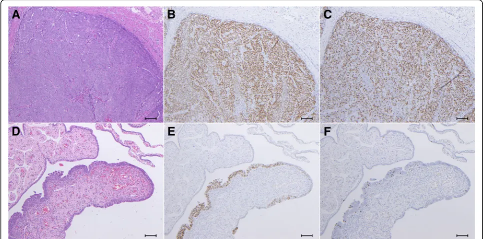 Table 1 Mutations detected by target-gene sequencing of the retroperitoneal high-grade serous carcinoma