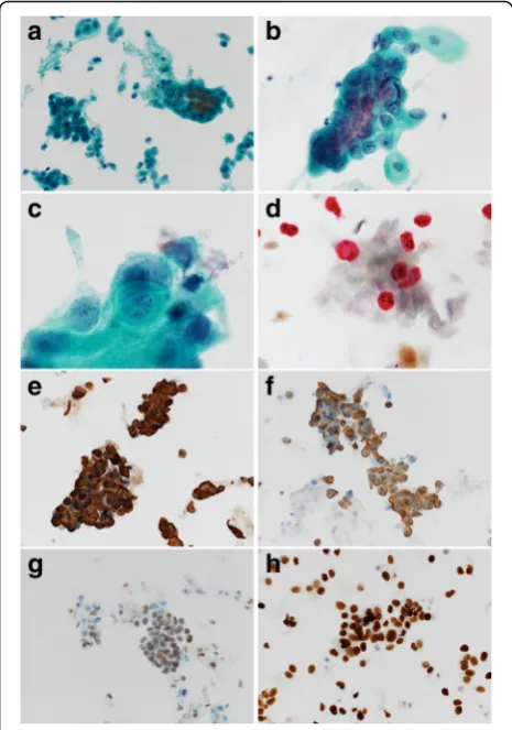 Fig. 1 Photomicrographs of pagetoid urothelial intraepithelialneoplasia extending to the vagina