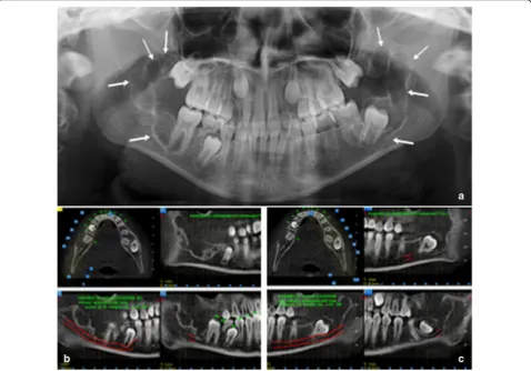 Fig. 3 TA, female, diagnosis at age 9 (4-gen-2008) - a Panoramic radiography shows on both side of the mandible two symmetric large multilocularradiolucent lesions involving the angle and the ramus regions (white arrows)