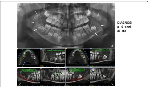 Fig. 7 TA, female, diagnosis at age 9 – a-d and e-h: respectively the lesion of the right mandibular side and the left mandibular side