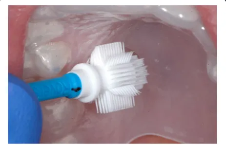 Fig. 1 Splint for upper jaw with Orcellex® brush in situ