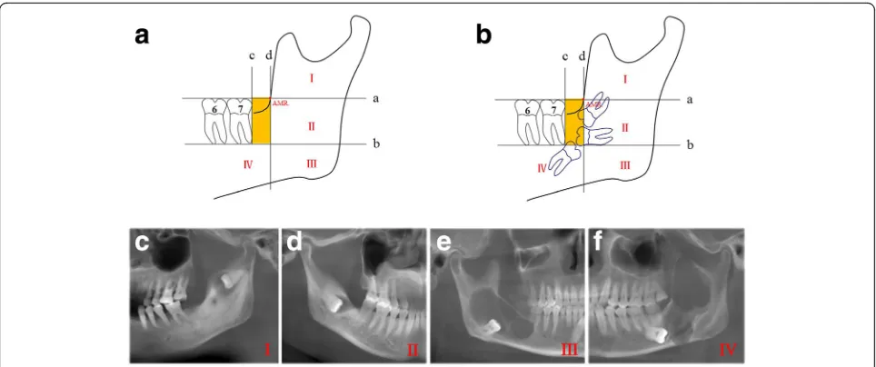 Fig. 1 Definition and classification of ectopic mandibular third molar based on panoramic images.four levels (I-IV) were defined as ectopic locations for the mandibular third molar.as marked as the yellow area or contact with this area were defined as impa