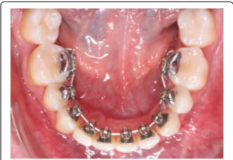 Fig. 1 A completely customized lingual appliance (WIN, DW LingualSystems, Bad Essen, Germany) bonded to the lingual surfaces of theteeth in the lower jaw