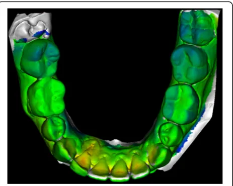 Fig. 3 Orthopantomogram of a patient before orthodontic treatment.Lengths of the crown and root of the incisor with the torque discrepancywas measured and compared to the lengths of the crown and the rootafter treatment