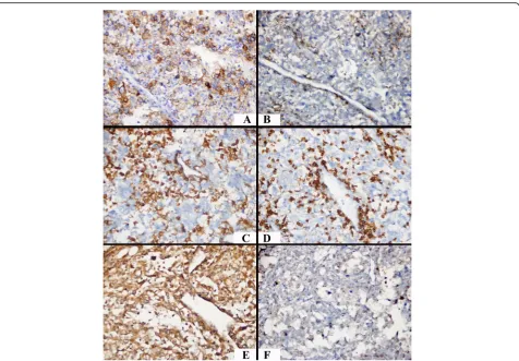 Fig. 1 A PD-L1-positive case with an increased lymphocyte density in the microenvironment and high HIF-2dense lymphocytic infiltration.α, low HIF-1α expression (× 400).a PD-L1 positivity with prominent membranous and scarce cytoplasmic staining