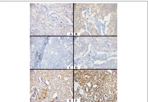 Fig. 2 A case exhibiting PD-L1-expression in a few cells with a mild lymphocyte density in the microenvironment, low HIF-2α expression, andhigh HIF-1α expression (× 400)