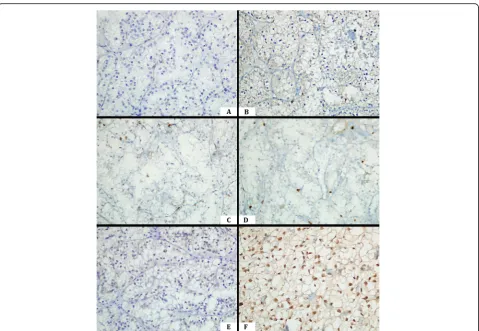 Fig. 3 A PD-L1 negative case with a mild lymphocyte density, low HIF-2PD-1-positive mild lymphocytic infiltration,α expression, and high HIF-1α expression (× 400)