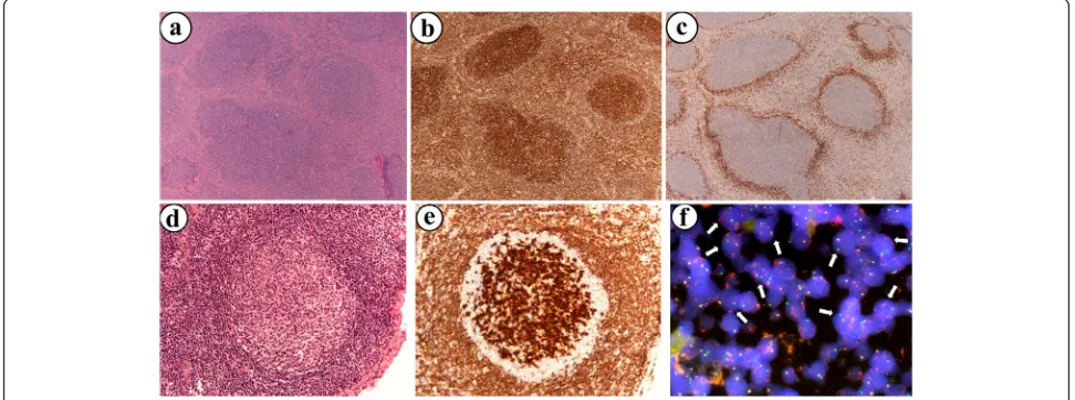 Fig. 1 Follicular lymphoma case for representative demonstration ((H&E) staining (the in situ neoplasia cells using the FICTION technique (a-c) with H&E staining (a), BCl2 (b) and IgD (c) staining, respectively (Originalmagnification × 400)