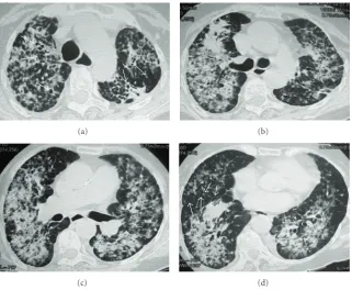 Figure 1: Chest radiographs in anteroposterior (a) and lateral incidence (b) showing hyperinﬂated lungs, with bilateral nonhomogeneousopacities, predominantly in the middle third of right lung.