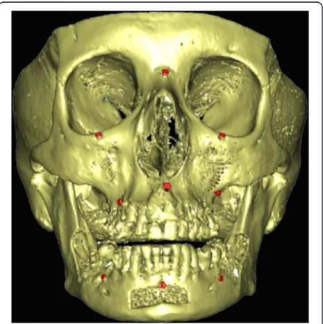 Fig. 1 Frontal 3D CT scan image view showing the nine corticalbone screws (in red) placed as references to define a three-dimensional coordinate system (3 in the skull, 3 in the maxilla and 3in the mandible)