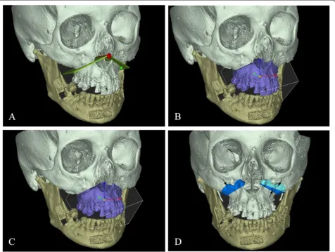 Fig. 2 a Generation of the plane for the virtual maxillary’s osteotomy (b) Segmentation of 3-D bone segments corresponding to the Le Fort Iosteotomy (c) Repositioning of the maxillary osteotomized segment according to the planned movements (d) Generation of specific maxillarycutting guides to reproduce the planned virtual Le Fort I-type osteotomy (arrows)