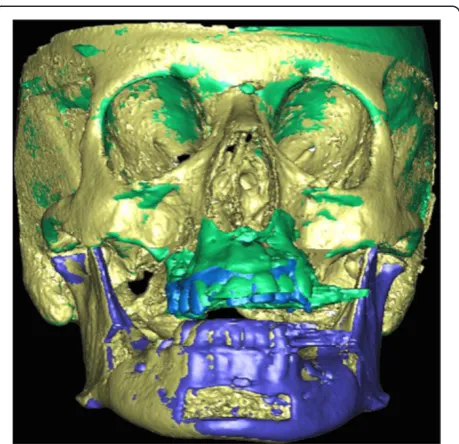 Fig. 5 Planned pre- and post-operative 3D CT scan images fused bymeans of an automated surface matching method by using theskull, which was not repositioned by the surgery, as referencefor registration
