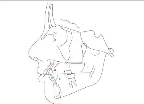 Figure 5 The angulation of the maxillary incisors (angle A var. 24) and mandibular incisors (B, var
