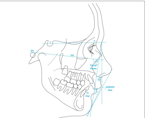 Figure 7 Facial planes used in the present study as well as the two angles used to describe chin prognathism (according to Holdaway [22,23]).