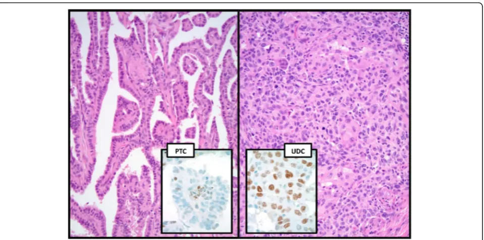 Table 4 BRAFV600E expression in thyroid nodular hyperplasiasand follicular cell-derived carcinomas