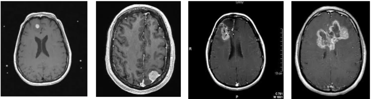 Figure 3. Brain Tumor MR images for classification  Image Features 