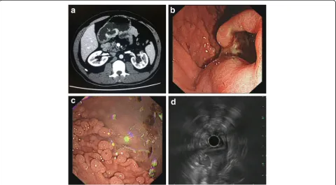 Fig. 1 CT, endoscopy and ultrasonography examination.surface ( a Abdominal CT shows a broad-based, protruding mass with deep ulceration on thearrow), arising from the sub-mucosal layer of the gastric antrum along the lesser curvature of the stomach