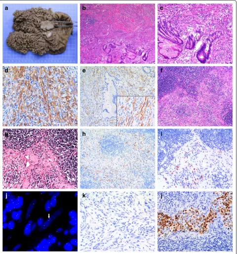 Fig. 2 Gross and microscope observations. A protruding mass with white cut surface in the gastric antrum and many fundic gland polypsin situ hybridization analysis of ALK rearrangement in inflammatory myofibroblastic tumor using Vysis break apart probe kit