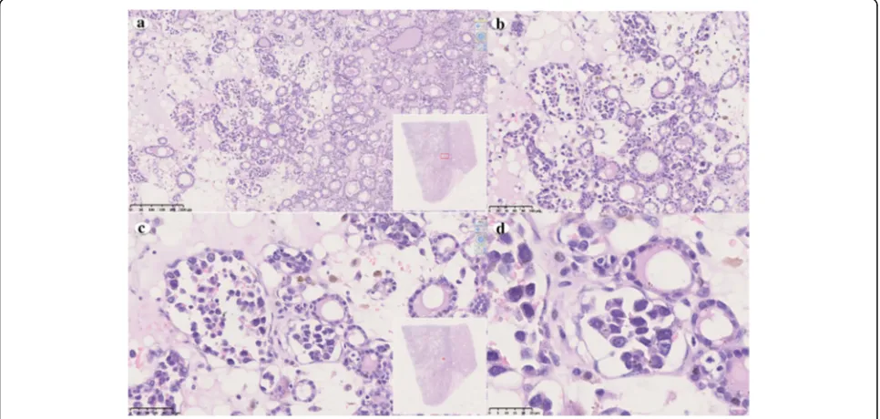 Fig. 2 Histopathological features of thyroid intravascular large B-cell lymphoma. a Tumor cells are located in the interstitial of thyroid follicularwithout forming a clear boundary line (original magnification ×100)