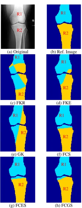 Fig. 5:  (a) Original X-ray image, (b) Manually  segmented reference of (a). Fig. (c) – (h) the  segmented results of (a) using FKR, FKE, GK, 
