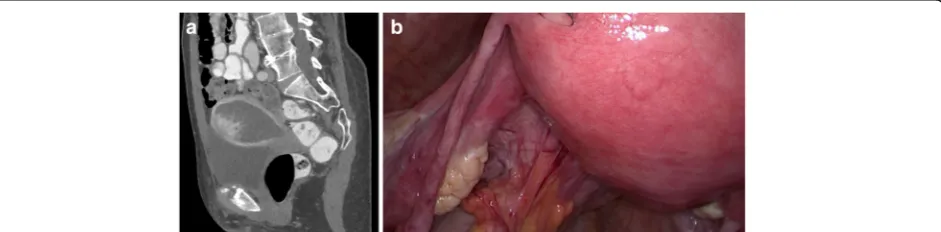 Fig. 1 Radiological and intra-operative findings: a CT radiography showed a serometra with a polypoid exophytic tumour mass with irregular borderswith adjacent organs; b the situs during surgical laparoscopy with enlargement of the uterine fundus, inconspicuous serosal surface and ovaries