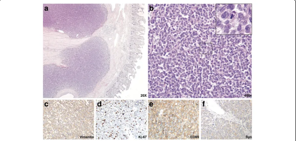 Fig. 2 Gross features of the tumor with the resected ileum