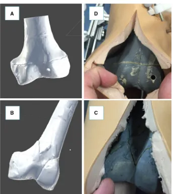 Fig. 9 Experimental validationcorrespondent physicalreduction achieved by therobotic system, (results examples: virtualreduction in the fractureperformed by the surgeon on asimple fracture (a) and on anarticular Y-shape fracture (b);c, d)respectively