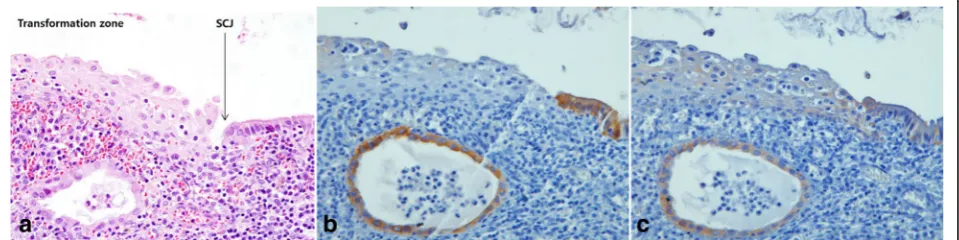 Fig. 1 Expression of CK7 and CK19 in non-neoplastic cervix. HE staining shows the transformation zone and SCJ cells (arrow) (a)