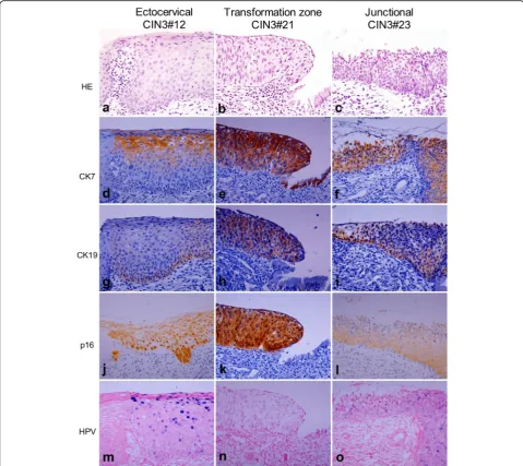 Fig. 4 Expression pattern of CK7, CK19, p16, and HR HPV in CIN3. HE staining shows representative CIN3s developing in the ectocervix (CIN3#12)in CIN3#21 ((a), transformation zone (CIN3#21) (b), and SCJ (CIN3#23) (c), respectively