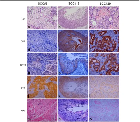 Fig. 7 Expression pattern of CK7, CK19, p16, and HR HPV in squamous cell carcinoma (SCC)