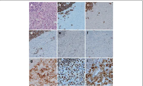 Fig. 3 High-magnification histological findings from the biopsyspecimen. Diffuse infiltration of large lymphoid cells that are similarto centroblasts or immunoblasts