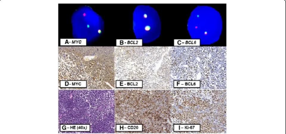 Fig. 1 Morphological, cytogenetic and immunohistochemical aspects of patient 1. Key: Imagesexhibit the negativity for Bcl2 (below 70% of marked cells) and Myc in immunohistochemistry (below 50% of marked cells)