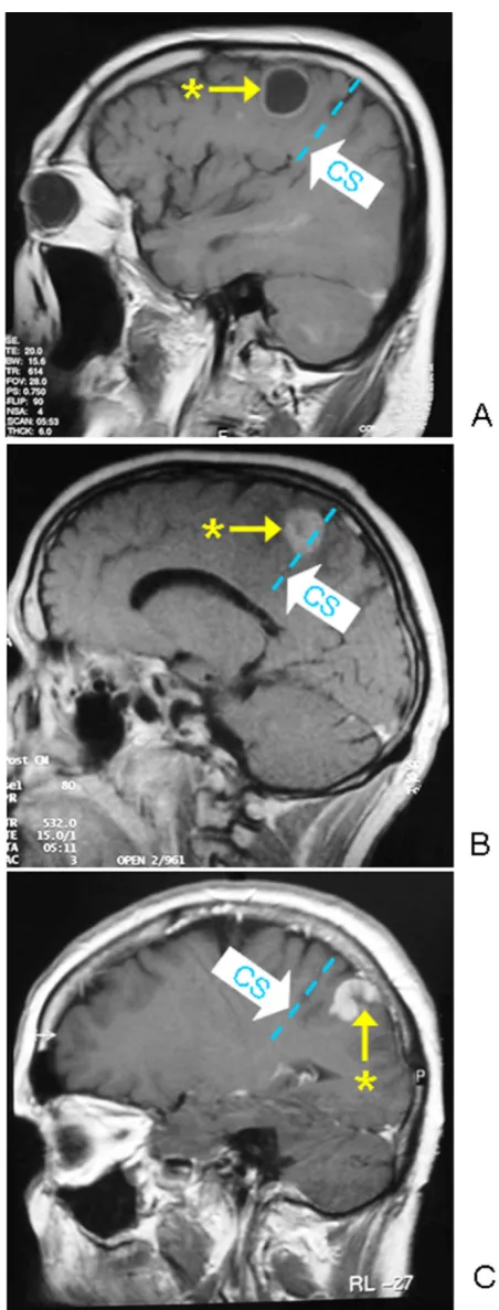 Figure 1Gadolinium enhanced T1 weighted sagittal MR images showing examples of lesions that are located frontal to Brodman Area 4 ((A), dorsal to Brodman Area 4 (C) or had direct contact with Brodman Area 4 (B)Gadolinium enhanced T1 weighted sagittal MR im