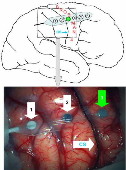 Figure 2Placement of a 6-contact strip electrode on the cortexPlacement of a 6-contact strip electrode on the cortex