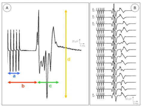 Figure 3with a: stimulation artifact; b: latency (in ms); c: potential (A) Individual compound muscle action potential (CMAP) width (in ms) and d: amplitude (in µV)(A) Individual compound muscle action potential (CMAP) with a: stimulation artifact; b: latency (in ms); c: potential 