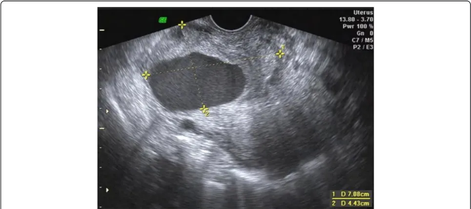 Figure 1 Two-dimentional ultrasound image of the pseudoaneurysm. The pseudoaneurysm is visible in the anterior wall of the lower part ofthe uterus