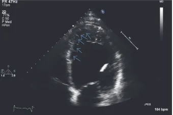 Figure 1: EKG showing sinus rhythm with premature ventricularcomplexes and nonspecific T wave changes.