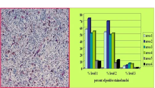 Figure 7cinoma (in association to the distance of the nearest vessel (proliferating nuclei are stained brown, vessels are stained red)Example of an active sampling to determine the discrimination threshold of a Mib-1 PAP stained undifferentiated large cell