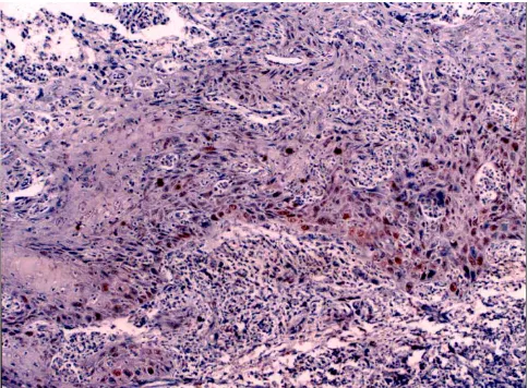 Figure 8SCC (× 250)Strong Topo IIα positivity is seen in poorly differentiated Strong Topo IIα positivity is seen in poorly differenti-