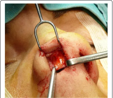 Figure 3 The alar cartilages exposed.