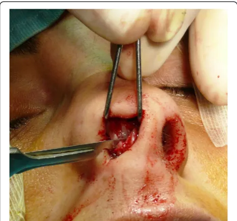 Figure 8 The suture is performed firstly with separate stitchesin the submucosa and then on the mucosa.