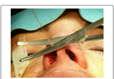 Figure 13 The suture is performed firstly with separate stitchesin the submucosa and then on the mucosa.