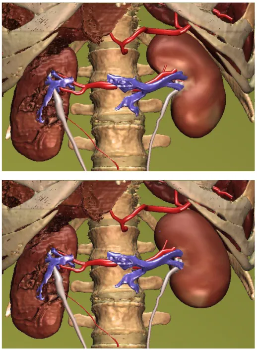 Figure 6: Visualization of shape variants of the kidney within the VOXEL-MAN atlas. The  left kidneys (in the pictures on the right hand side) are surface representations on the basis of  m-rep models