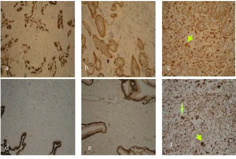 Figure 3Immunohistochemical stains on core breast biopsy tissueImmunohistochemical stains on core breast biopsy tissue