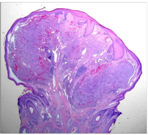 Figure 18Ecchymotic Kaposi sarcomaEcchymotic Kaposi sarcoma. The spindled cell prolifera-tion in this example is somewhat obscured by the extensive purpura.