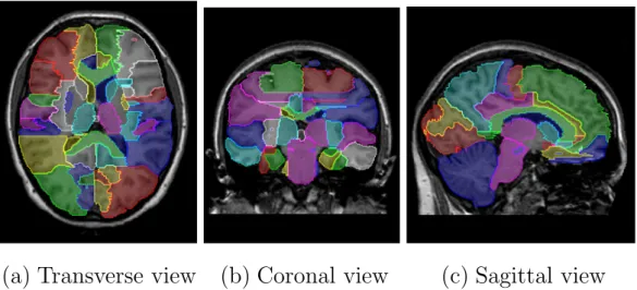 Figure 2.5: One of the manually delineated brain atlases used in this work shown overlaid onto the corresponding MR image.