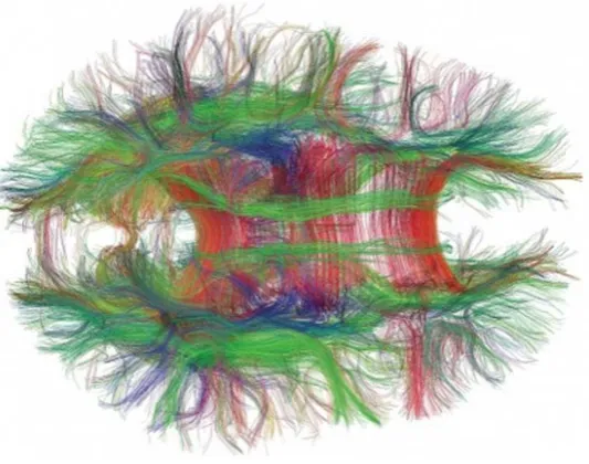Figure 3. Connectome (brain-graph) viewed from above, created with Diffusion Tensor dit Imaging (DTI), showing complex arrangement of fibrous white matter tracts