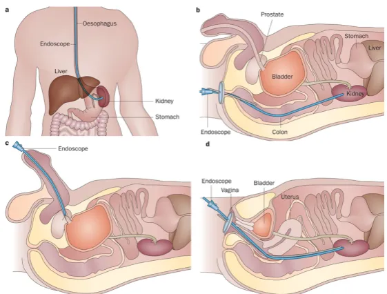Figure 2.10: NOTES approaches (a) Transgastric nephrectomy (endoscopic access tothe kidney via the stomach), (b) Transrectal nephrectomy (the instruments areprogressed through the wall of the colon), (c) Tranurethral prostatectomy and (d)Transvaginal nephrectomy (Tyson and Humphreys (2014), permission by NaturePublishing Group1)