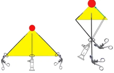 Figure 2.12: Triangulation of instruments in multi-port surgery (left) and SPA (right)(red dot: target organ) (Chiu et al